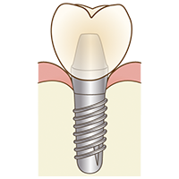 インプラント